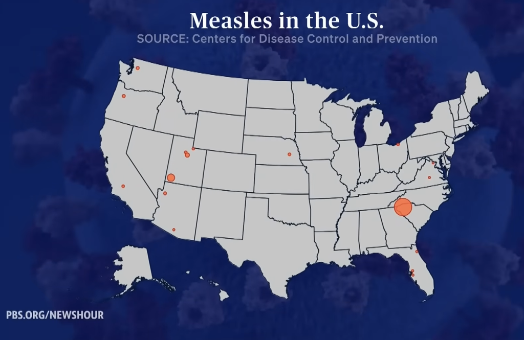 A CDC map titled “Measles in the U.S.” shows measles cases across the country, with dots marking affected states and larger circles indicating areas with higher numbers of cases.